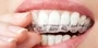 Clear Aligner Systems Braces Dental South Africa