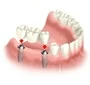 Dental Implant To Replace Multiple Teeth