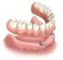 Implant Provide Retention For Dentures